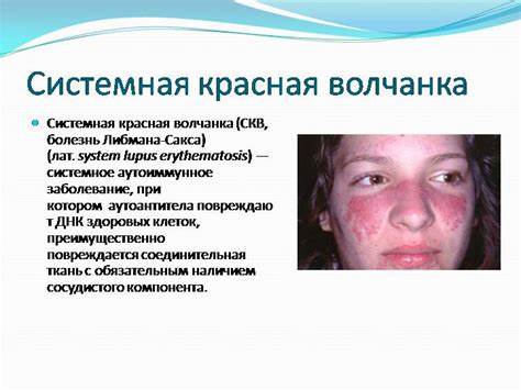 Диета системная красная волчанка Болезнь красная волчанка: описание и как выглядит, причины заболевания Болезнь красная волчанка: описание и как выглядит, причины заболевания Диета системная красная волчанка