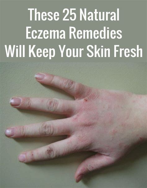 These 25 Natural Eczema Remedies Will Keep Your Skin Fresh Eczema