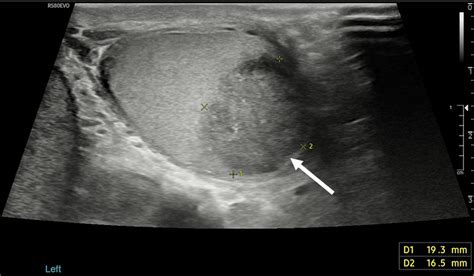 Scrotal Cyst Ultrasound