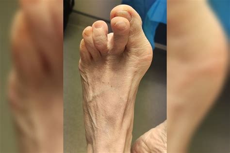 28 Bunion Overlapping 2nd Toe Correction Before Foot Podiatry