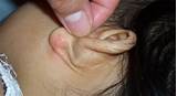 Ear Psoriasis Treatment Photos