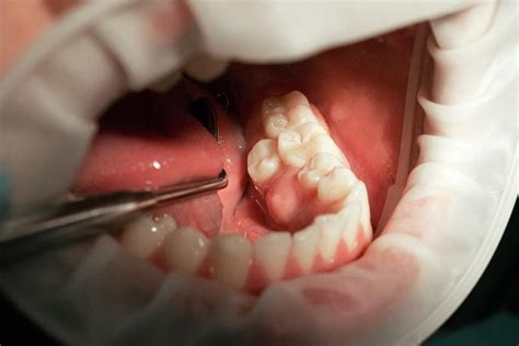Supernumerary Premolar Tooth Photograph By Dr Armen Taranyan Science