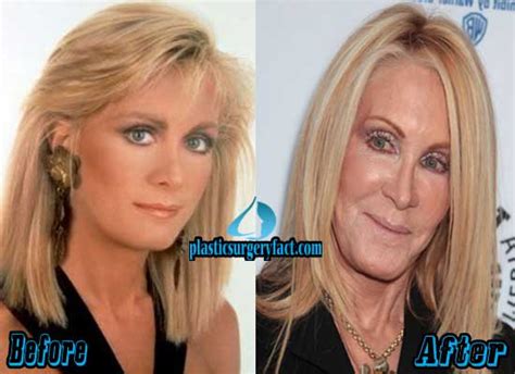 Joan Van Ark Plastic Surgery Before And After Pictures Plastic Surgery Facts