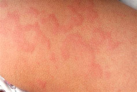 10 Signs Of Scabies Facty Health