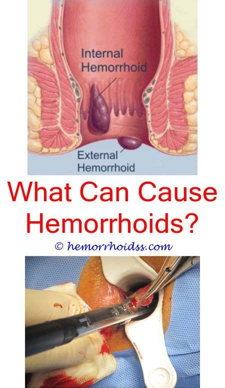 How long do hemorrhoids last and can they go away on their own? #internal #hemorrhoids how long does a prolapsed ...