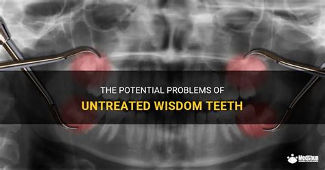 The Potential Problems Of Untreated Wisdom Teeth Medshun