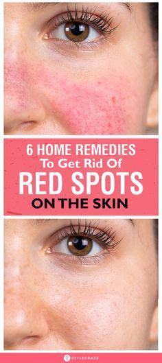 How To Get Rid Of Red Spots On Face 6 Home Remedies And Tips Since