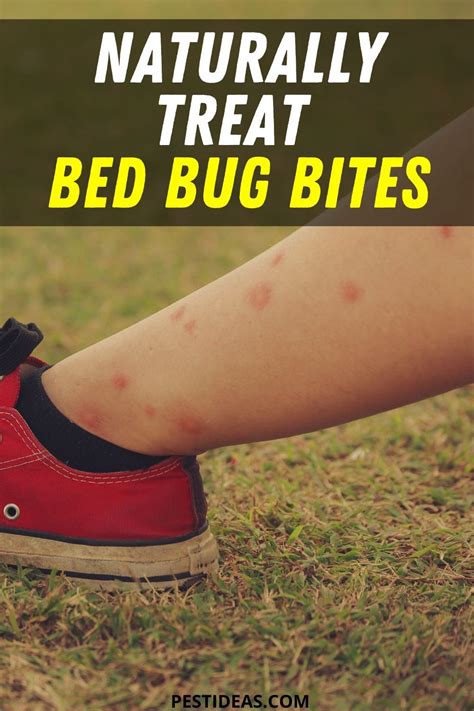 Naturally Treat Bed Bug Bites Bed Bug Bites Bed Bugs Bug Bites