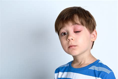 Eye Injuries When To Go To The Er Beaumont Emergency Hospital