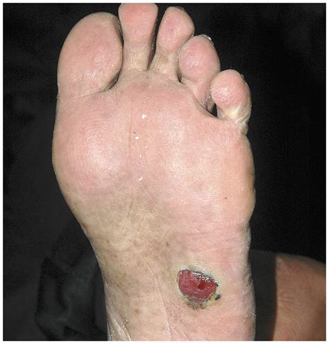 Melanoma Of The Foot Nejm