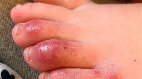 May have no other covid symptoms. 'COVID toes,' other rashes latest possible rare virus signs | WEAR