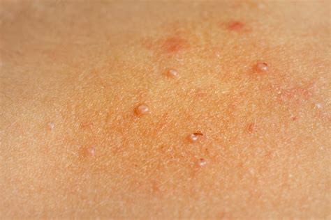What Is Molluscum Contagiosum Pictures Causes And Treatment Goodrx