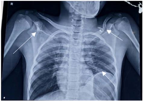 X Ray Chest Pre Op X Ray Chest Ap View Showing Bilateral Clavicular