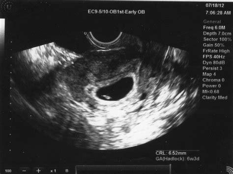 Estatenygw Pregnancy Week 6 Ultrasound Photos