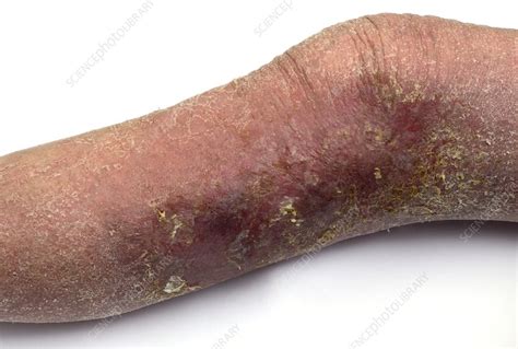 Eczema On The Lower Leg Stock Image C0166865 Science Photo Library