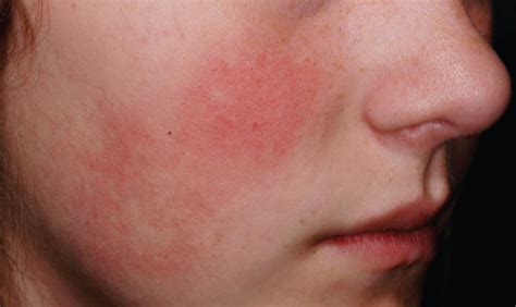 Are The Erythema And Roughness On A Young Girls Cheeks Treatable