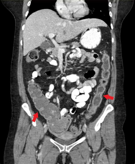 Ulcerative Colitis Associated Low Grade Dysplasia A Severe