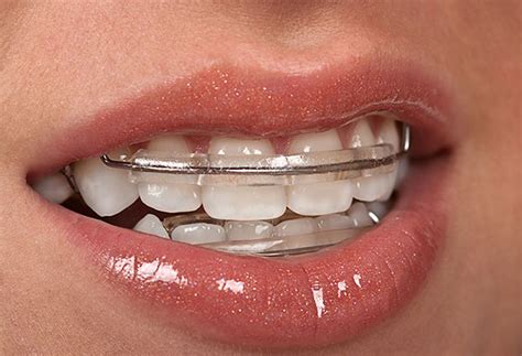 In these cases, it allows everyone to get past the paperwork and focus on building and executing. The Pros and Cons of Fixed Retainers and Removable Retainers