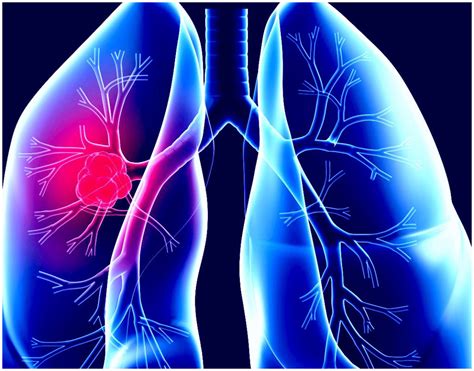 In a 2020 report published in case reports, a patient's first and only sign of pleural mesothelioma was gastric and colonic polyps discovered on an imaging scan. What Causes Mesothelioma - Tiwinefest