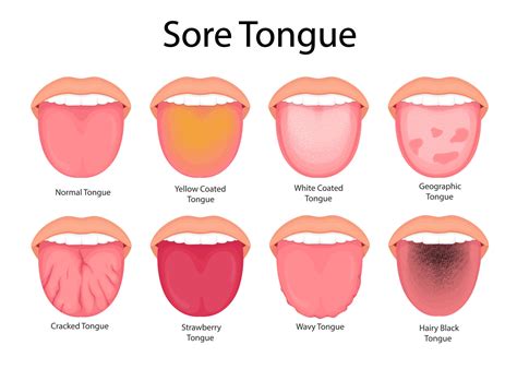 Illustration Of Tongue Symptoms And Health Medical Illustration