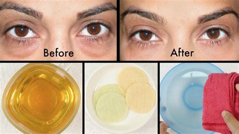 How To Get Rid Of Puffy Eyes Swollen Eyelids And Dark Circles Youtube