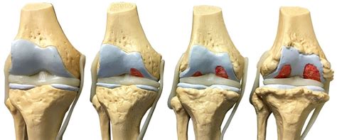 Knee Pain And Osteoarthritis Cyriaxphysio