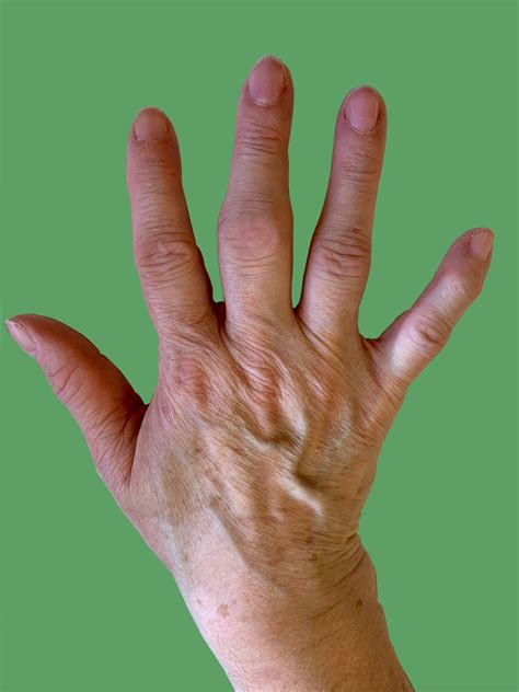 Osteoarthritis In The Hand Fife Virtual Hand Clinic
