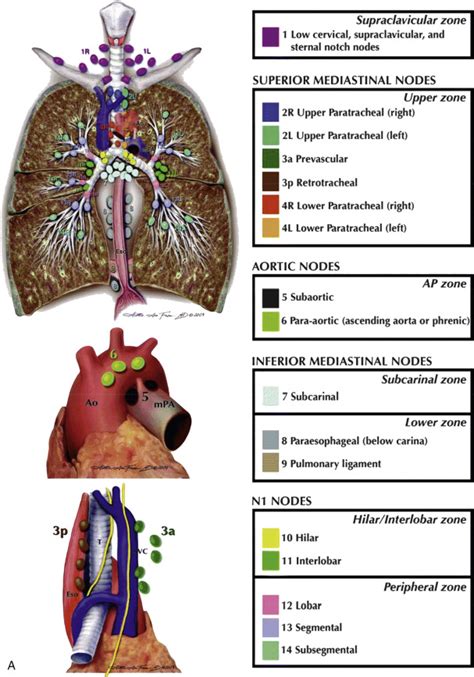 Mediastinum Lymph Node Abnormalities And Masses Radiology Key