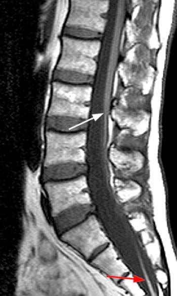 Tight Filum Syndrome Radsource