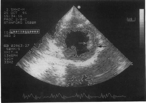 Real Time Parasternal Short Axis View Of The Left Ventricle At