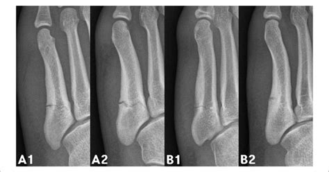 A New Classification Of Fifth Metatarsal Stress Fracture A Complete