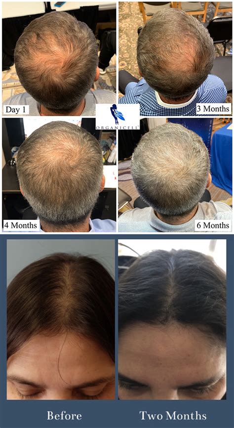 Exosome hair loss treatment in a young male. MICRODERMABRASION TREATMENTS MED SPA IN HOUSTON