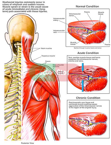 Myofascial Sprain Strain Doctor Stock