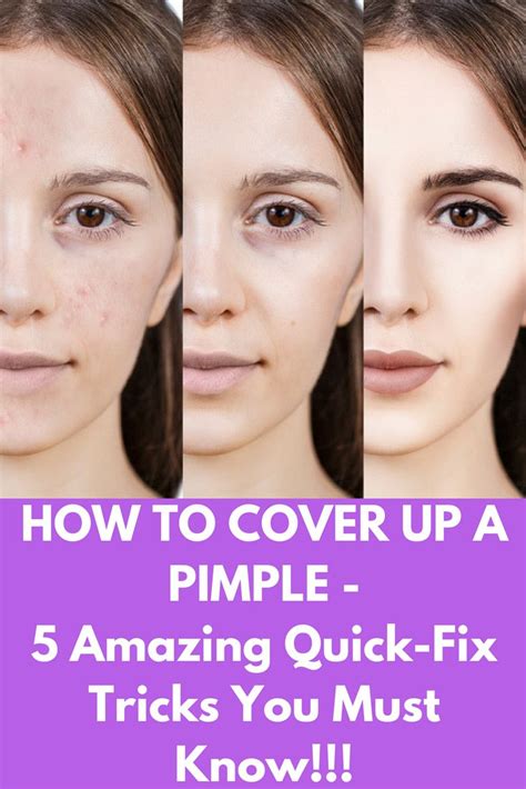 How To Cover Up A Pimple 5 Amazing Quick Fix Tricks You Must Know
