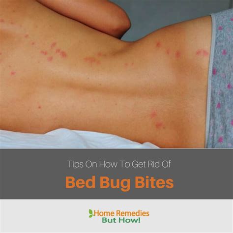 How To Get Rid Of Bed Bugs Bites 10 Proven Ways By Expert