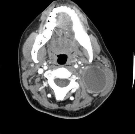 Second Branchial Cleft Cyst Radiology Reference Article Radiopaedia
