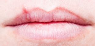 Weara ____ and helmet all the time you're in a boat. Why are my cold sores coming back, and how can I stop them?