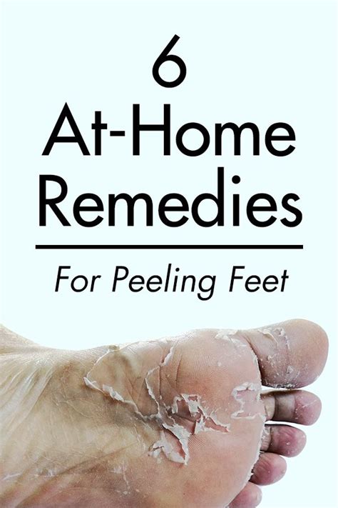 6 At Home Remedies For Peeling Feet Dry Feet Remedies Dry Cracked