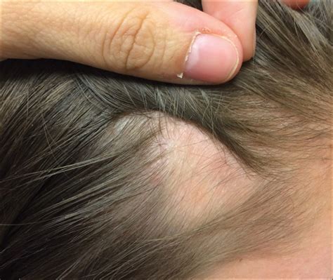 Patch Of Hair Loss On The Scalp Mdedge Dermatology