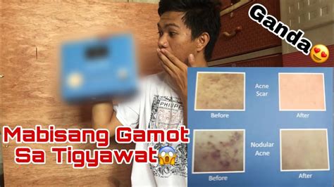 Mabisang Gamot Sa Tigyawat Eos Acne Cleanser And Acne Advance Serum