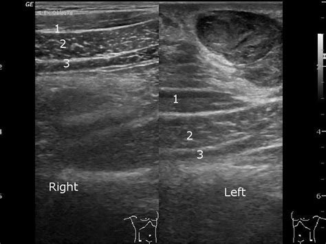 Anterior abdominal wall haematoma | Image | Radiopaedia.org