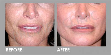 Mesotherapy has not been medically proven to prevent hair loss or restore hair. Mesotherapy - Hair Loss & Eye Bag Treatment | Premier Clinic