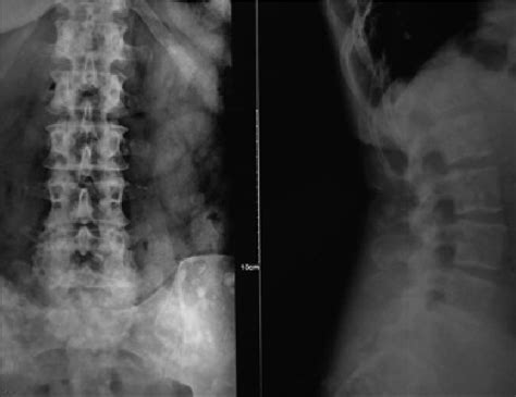 Radiografia De Columna Lumbar