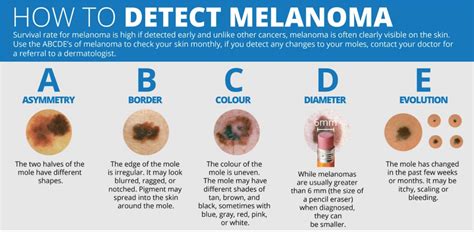 How To Detect Melanoma Using The Abcde Method The Weather Network