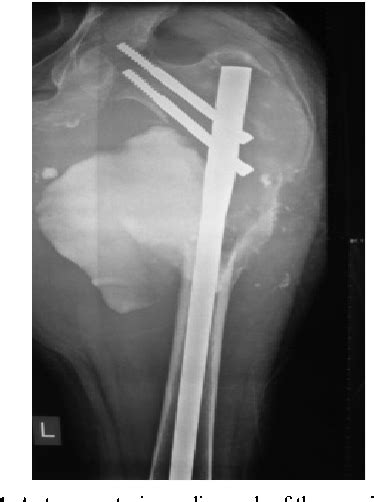 Figure 1 From A Proximal Femur Aneurysmal Bone Cyst Resulting In