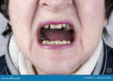 Destroyed Womans Teeth Stock Image Image Of Closeup 54387811