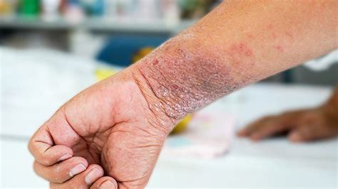 Top Symptoms Of Eczema Atopic Dermatitis Everyday Health