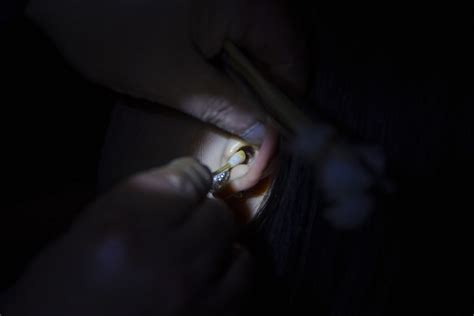 A Brown Recluse Spider Was Removed From This Womans Ear