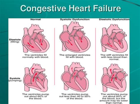 Heart failure (hf) is a complex of disorders caused mainly by a decrease in the contractility of the heart muscle. PPT - Congestive Heart Failure Case Study PowerPoint ...