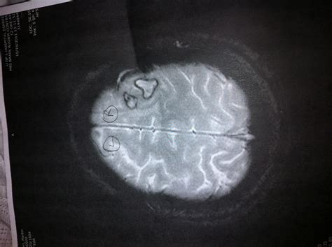 Tumor X Ray Picture Of Brain Tumor